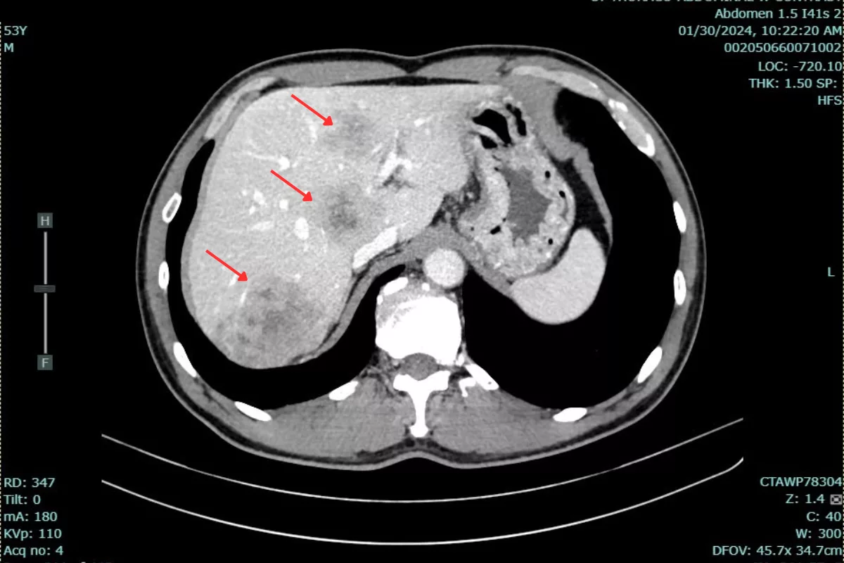 before treatment